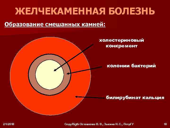 ЖЕЛЧЕКАМЕННАЯ БОЛЕЗНЬ Образование смешанных камней: холестериновый конкремент колонии бактерий билирубинат кальция 2/1/2018 Copy. Rigth