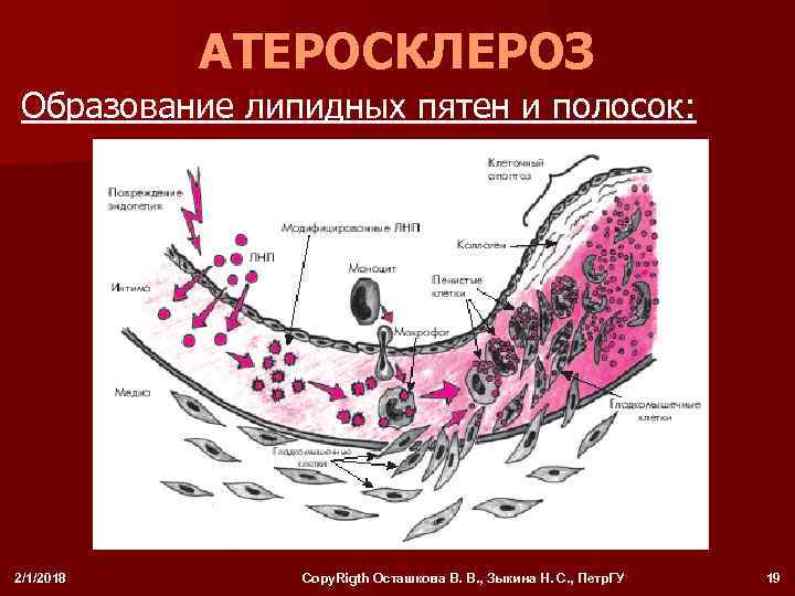 АТЕРОСКЛЕРОЗ Образование липидных пятен и полосок: 2/1/2018 Copy. Rigth Осташкова В. В. , Зыкина
