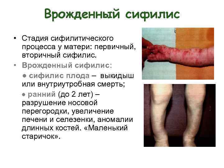 Врожденный сифилис • Стадия сифилитического процесса у матери: первичный, вторичный сифилис. • Врожденный сифилис: