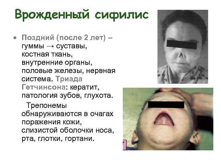 Врожденный сифилис Поздний (после 2 лет) – гуммы → суставы, костная ткань, внутренние органы,