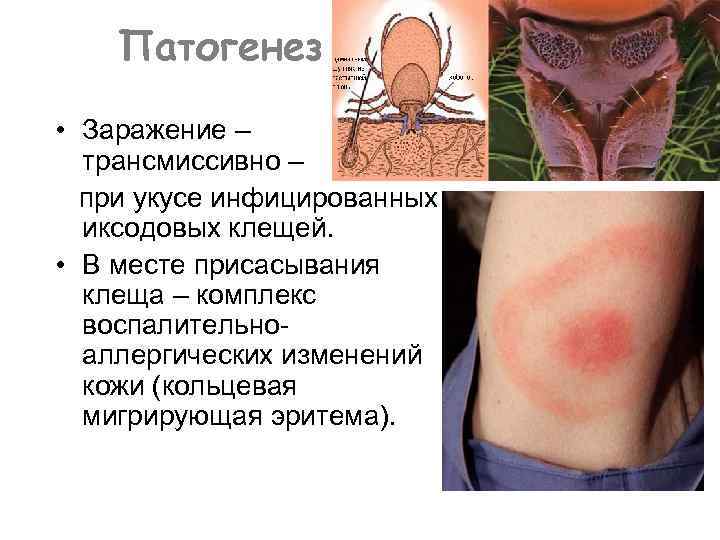 Патогенез • Заражение – трансмиссивно – при укусе инфицированных иксодовых клещей. • В месте