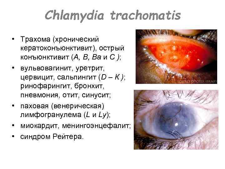 Chlamydia trachomatis • Трахома (хронический кератоконъюнктивит), острый конъюнктивит (А, В, Ва и С );