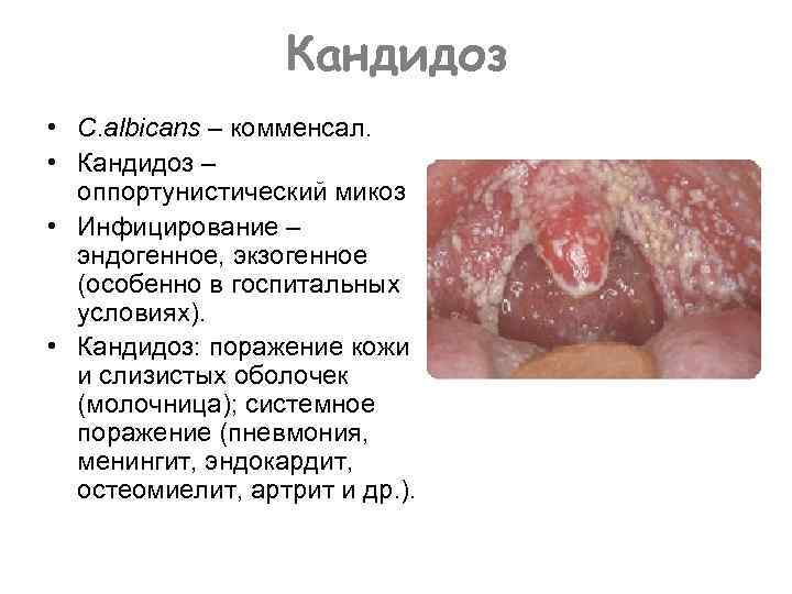 Кандидоз • C. albicans – комменсал. • Кандидоз – оппортунистический микоз • Инфицирование –