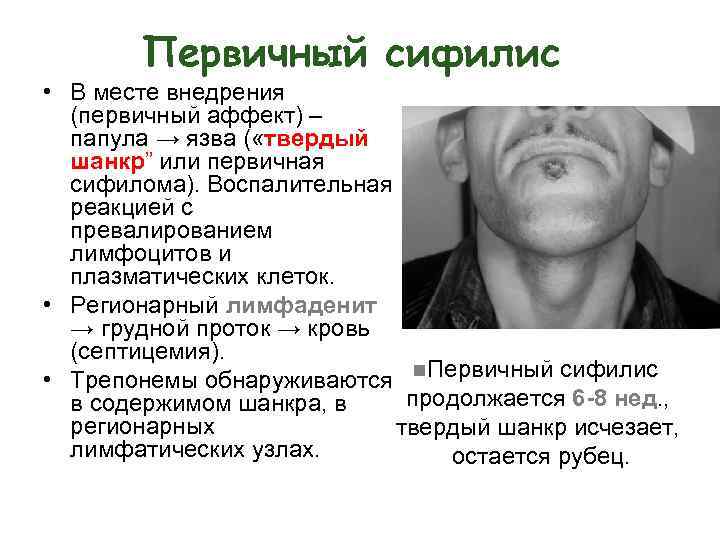 Первичный сифилис • В месте внедрения (первичный аффект) – папула → язва ( «твердый
