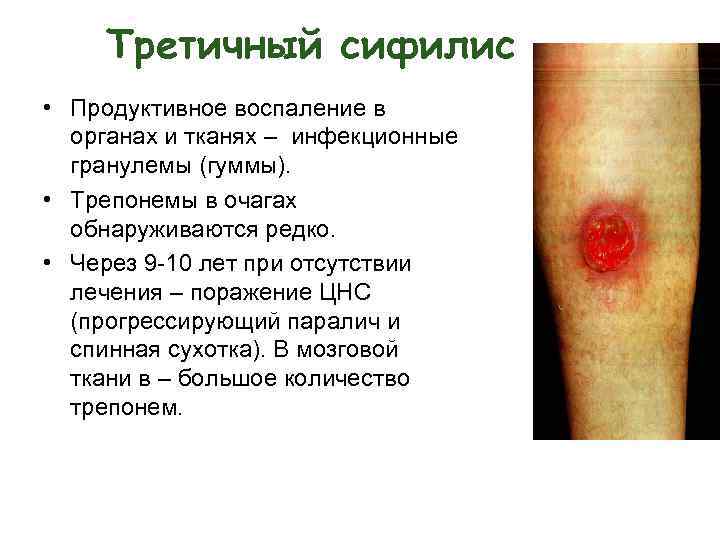 Третичный сифилис • Продуктивное воспаление в органах и тканях – инфекционные гранулемы (гуммы). •