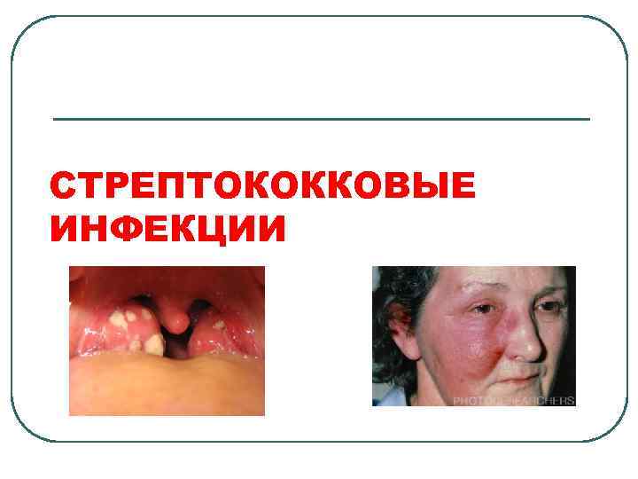 СТРЕПТОКОККОВЫЕ ИНФЕКЦИИ 