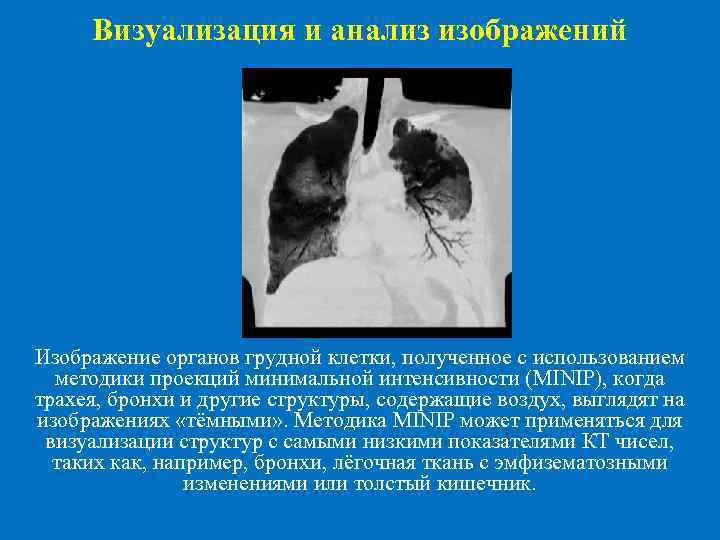 Визуализация и анализ изображений Изображение органов грудной клетки, полученное с использованием методики проекций минимальной