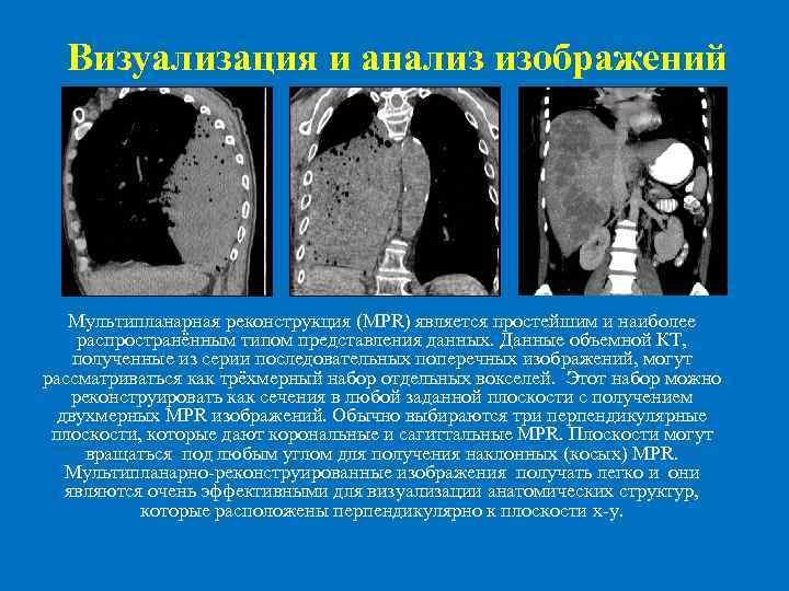 Реконструкция изображений в компьютерной томографии