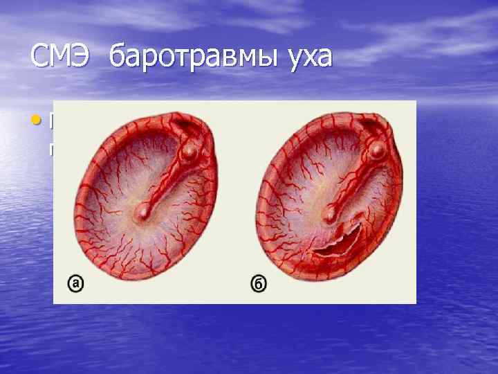 СМЭ баротравмы уха • Гиперемия и разрыв барабанной перепонки 