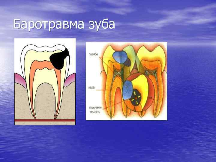 Баротравма зуба 