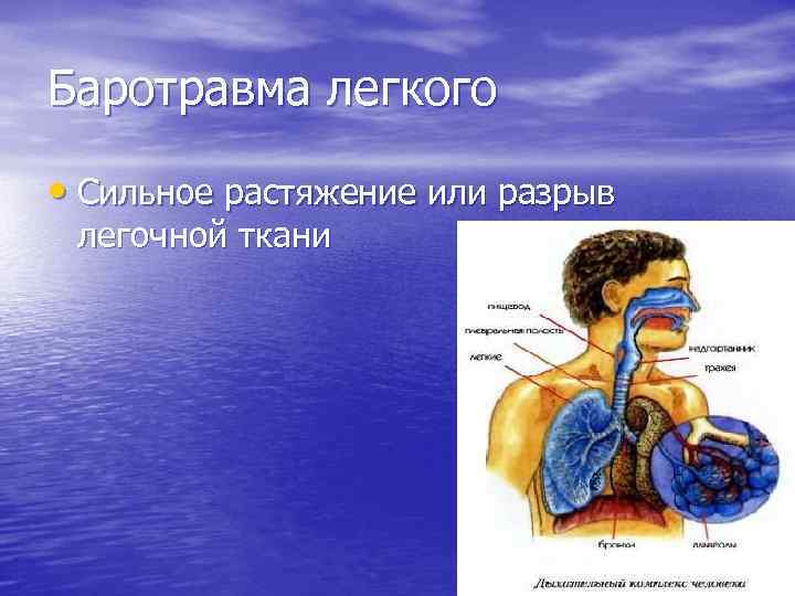 Баротравма легкого • Сильное растяжение или разрыв легочной ткани 