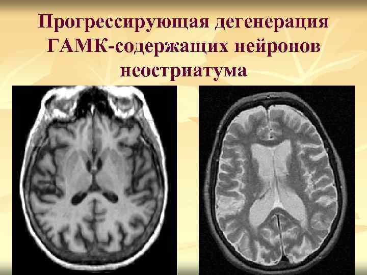 Прогрессирующая дегенерация ГАМК-содержащих нейронов неостриатума 