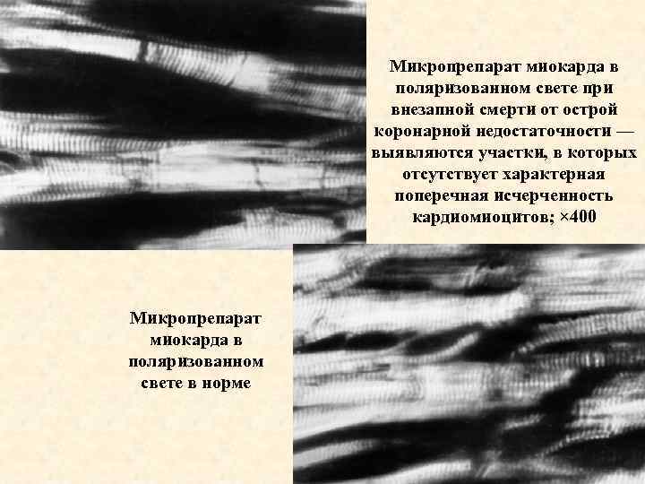 Микропрепарат миокарда в поляризованном свете при внезапной смерти от острой коронарной недостаточности — выявляются