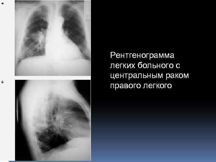 Рентгенограмма легких больного с центральным раком правого легкого 