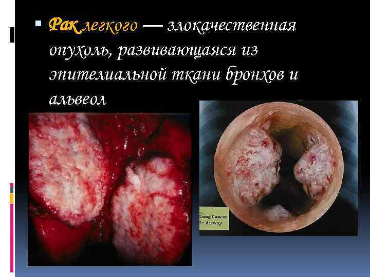  Рак легкого — злокачественная опухоль, развивающаяся из эпителиальной ткани бронхов и альвеол 