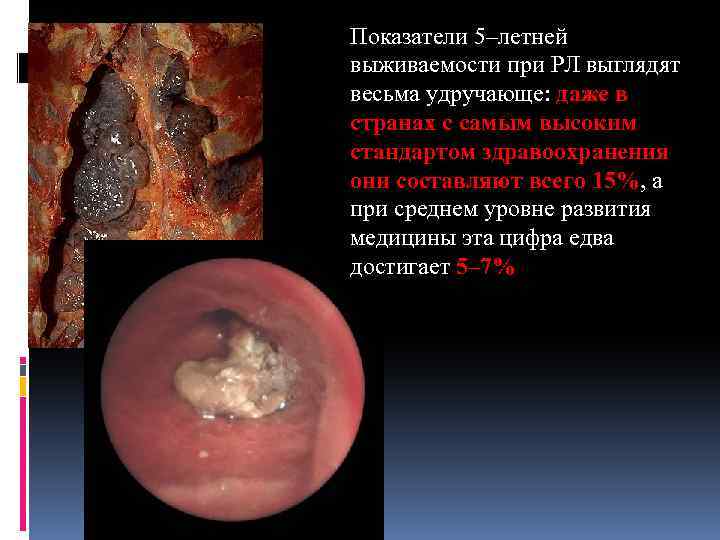 Показатели 5–летней выживаемости при РЛ выглядят весьма удручающе: даже в странах с самым высоким
