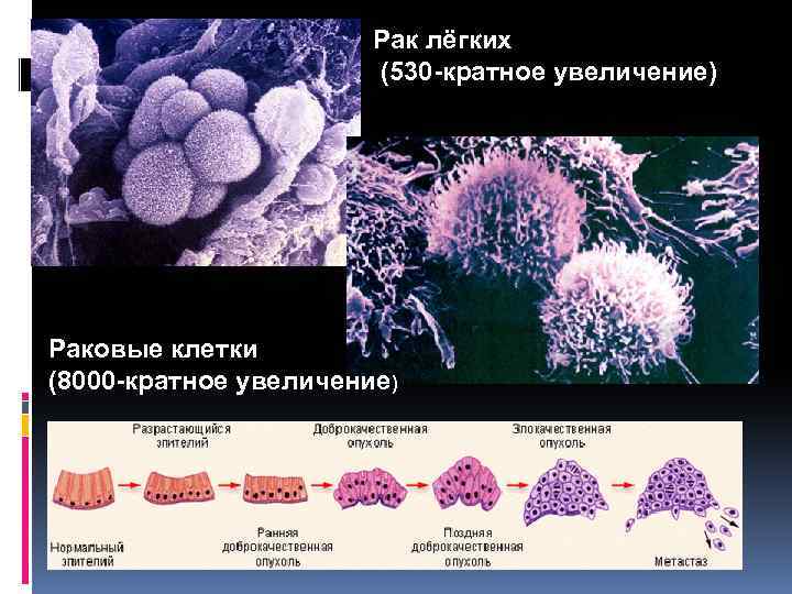 Рак лёгких (530 -кратное увеличение) Раковые клетки (8000 -кратное увеличение) 
