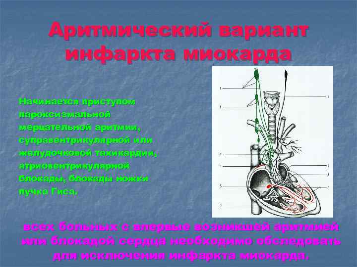 Аритмический вариант инфаркта миокарда Начинается приступом пароксизмальной мерцательной аритмии, суправентрикулярной или желудочковой тахикардии, атриовентрикулярной