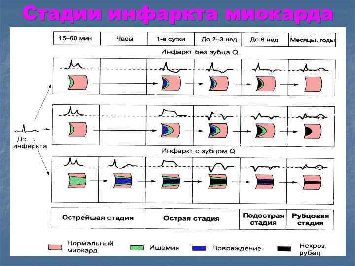 Стадии инфаркта миокарда. Cтaдия paзвития инфapктa миoкapдa пo тeчeнию:. Стадии инфаркта по дням. Стадии течения инфаркта миокарда. Подострая стадия инфаркта Длительность.