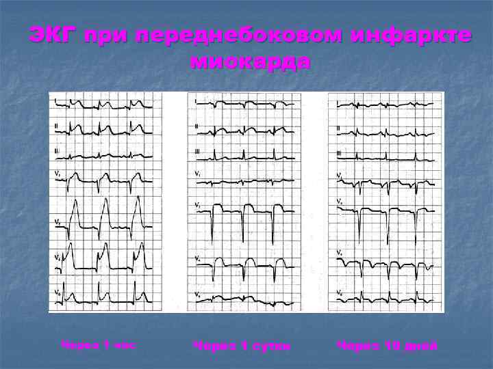ЭКГ при переднебоковом инфаркте миокарда Через 1 час Через 1 сутки Через 10 дней