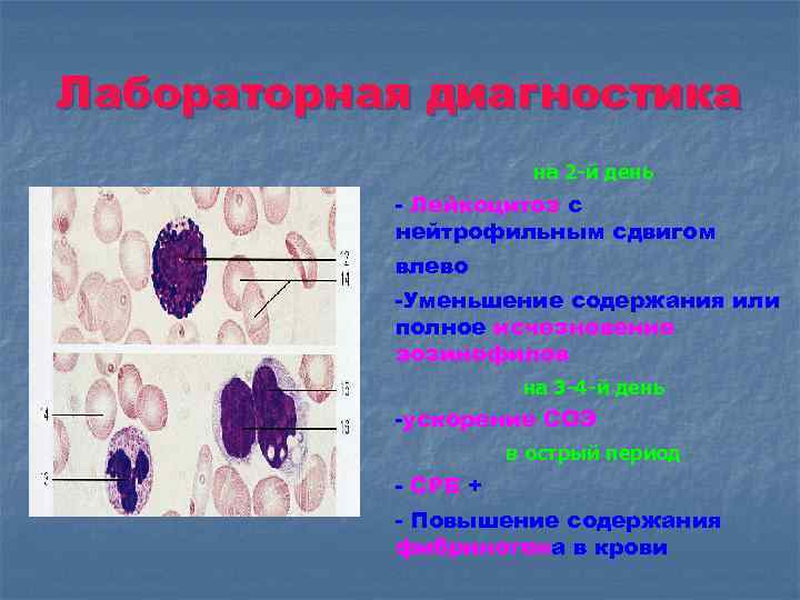 Лабораторная диагностика на 2 -й день - Лейкоцитоз с нейтрофильным сдвигом влево -Уменьшение содержания