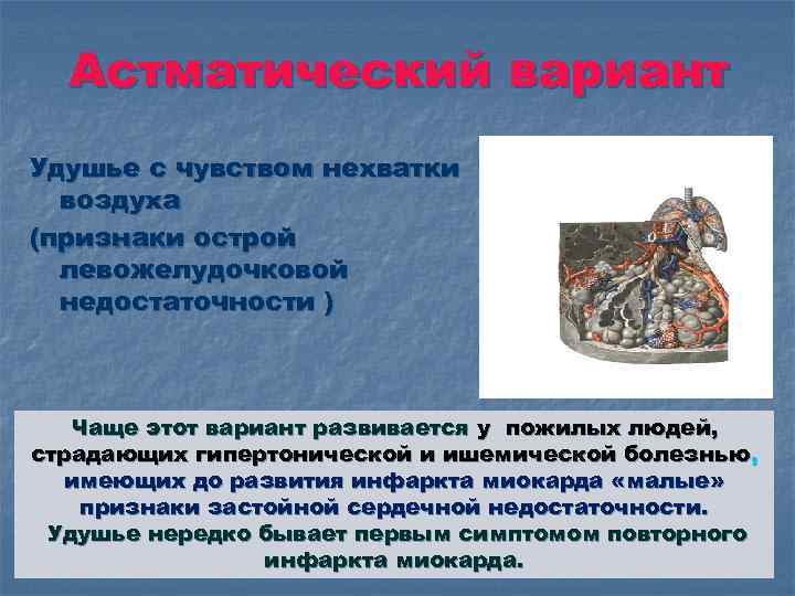 Астматический вариант Удушье с чувством нехватки воздуха (признаки острой левожелудочковой недостаточности ) Чаще этот