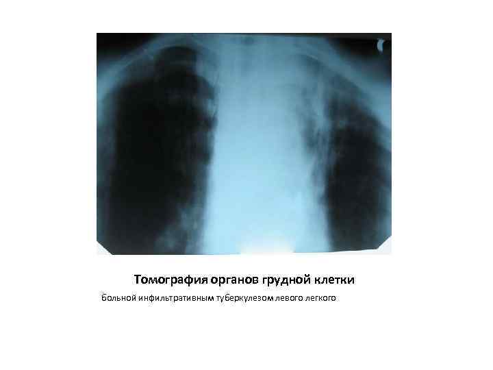 Томография органов грудной клетки больной инфильтративным туберкулезом левого легкого 