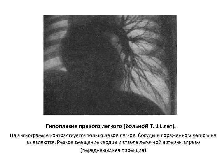 Гипоплазия правого легкого (больной Т. 11 лет). На ангиограмме контрастиуется только левое легкое. Сосуды