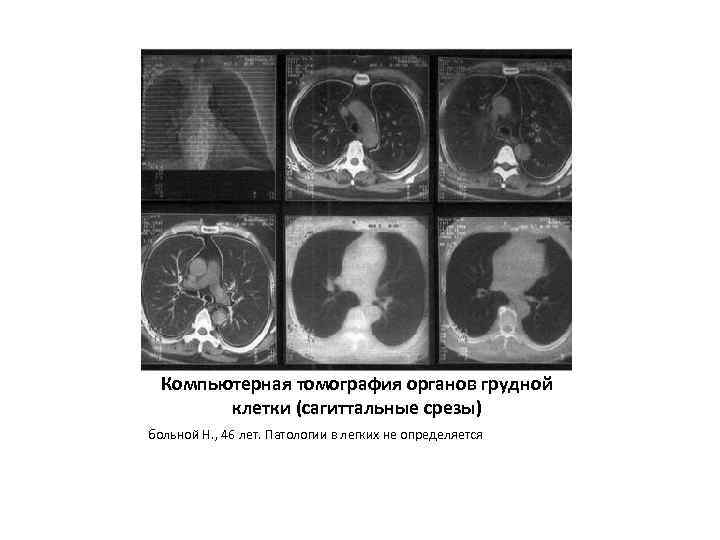 Компьютерная томография органов грудной клетки (сагиттальные срезы) больной Н. , 46 лет. Патологии в