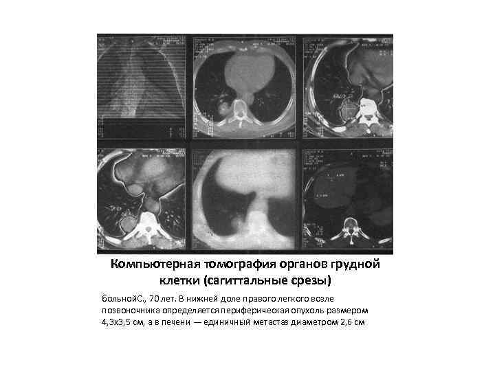Компьютерная томография органов грудной клетки (сагиттальные срезы) больной. С. , 70 лет. В нижней