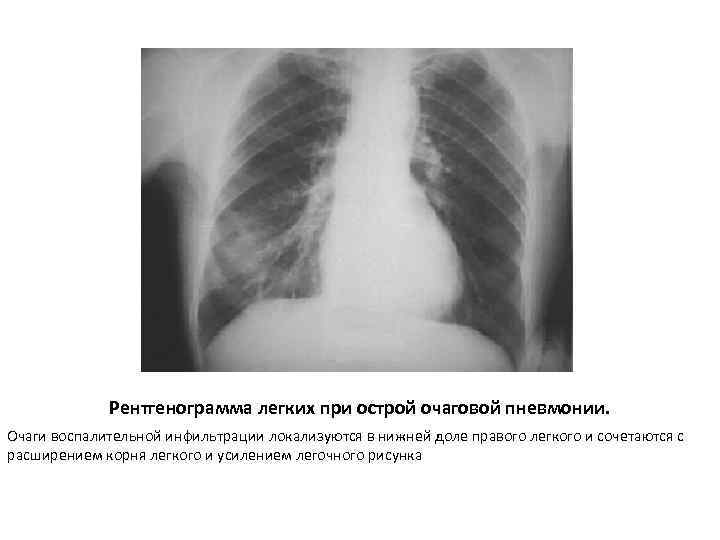 Расширение корней легких и усиление легочного рисунка