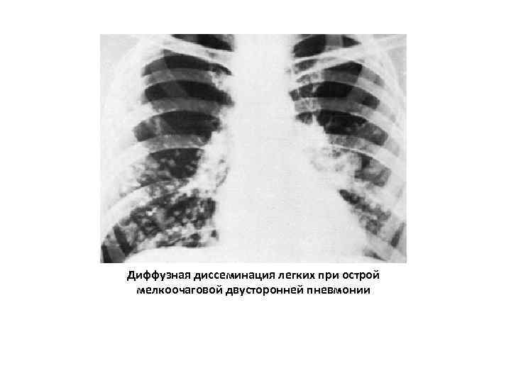 Диффузная диссеминация легких при острой мелкоочаговой двусторонней пневмонии 