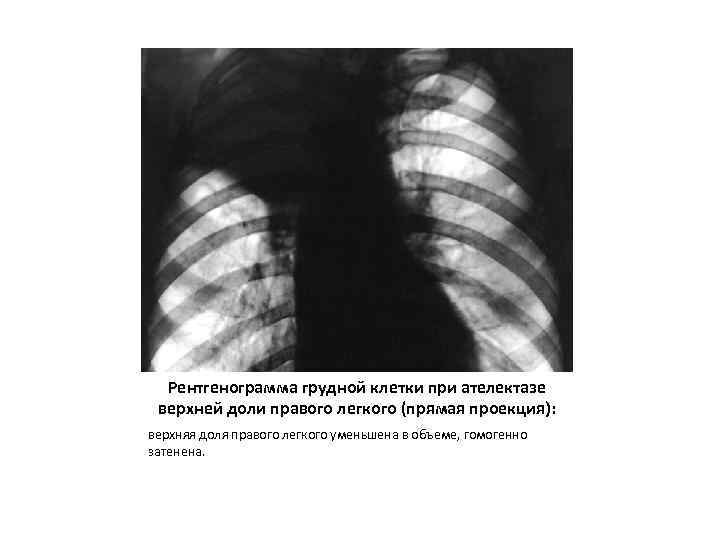 Рентгенограмма грудной клетки при ателектазе верхней доли правого легкого (прямая проекция): верхняя доля правого