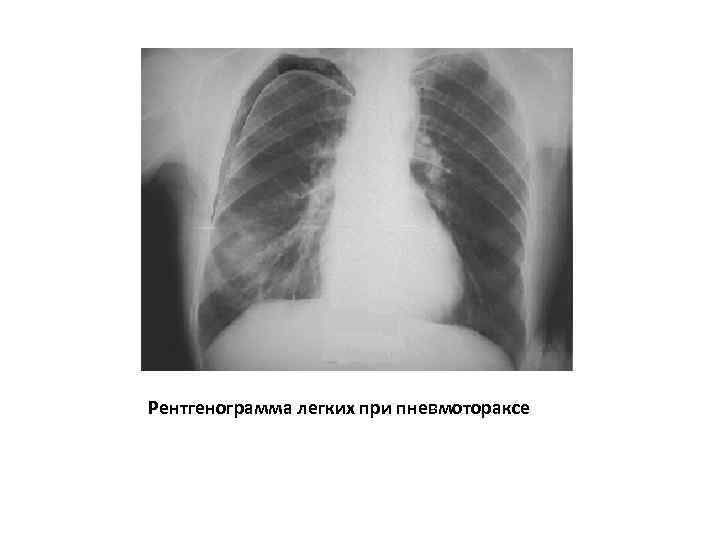 Рентгенограмма легких при пневмотораксе 