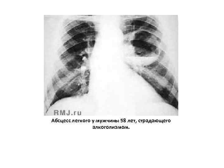 Абсцесс легкого у мужчины 58 лет, страдающего алкоголизмом. 