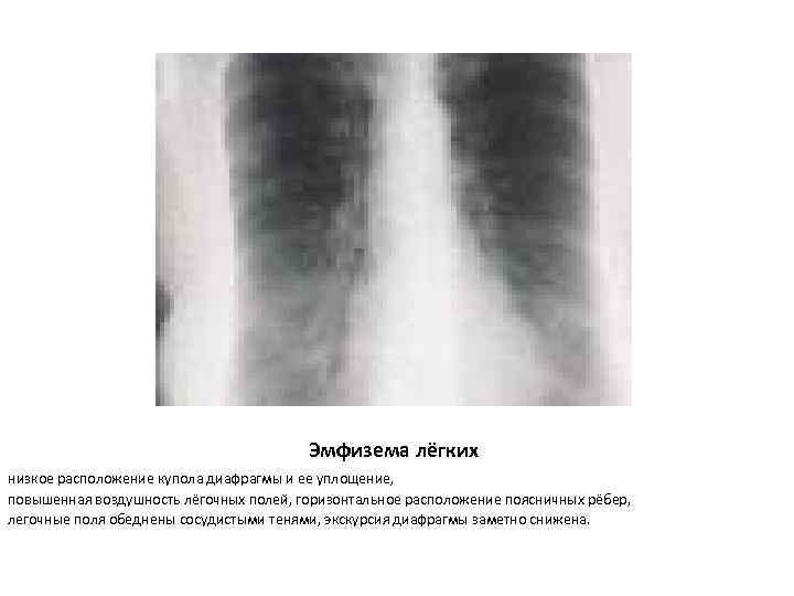 Эмфизема лёгких низкое расположение купола диафрагмы и ее уплощение, повышенная воздушность лёгочных полей, горизонтальное