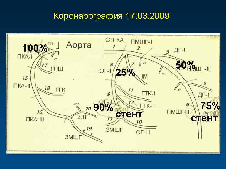 Коронарография 17. 03. 2009 100% 25% 90% стент 50% 75% стент 
