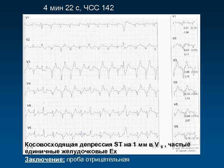 4 мин 22 с, ЧСС 142 Косовосходящая депрессия ST на 1 мм в V