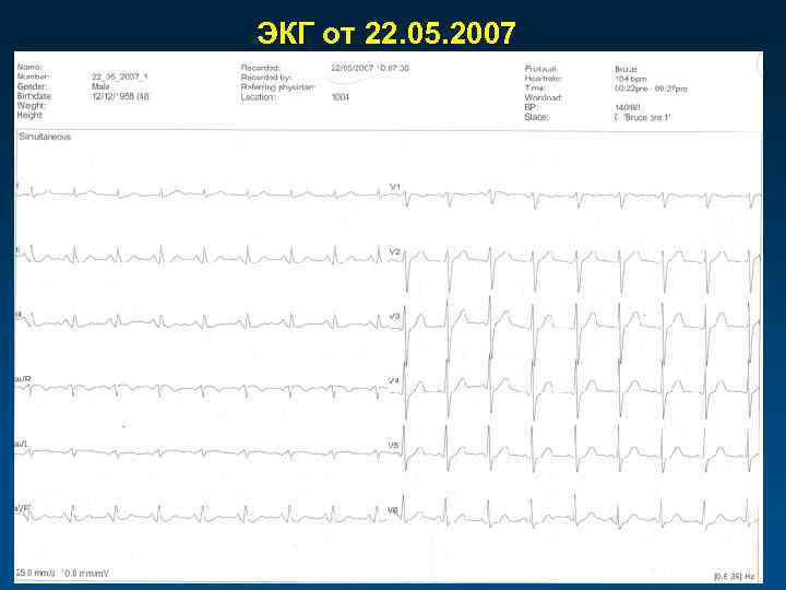 ЭКГ от 22. 05. 2007 