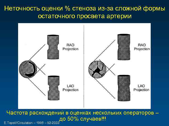 Неточность оценки % стеноза из-за сложной формы остаточного просвета артерии Частота расхождений в оценках