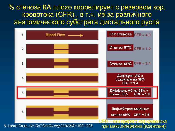 % стеноза КА плохо коррелирует с резервом кор. кровотока (CFR) , в т. ч.