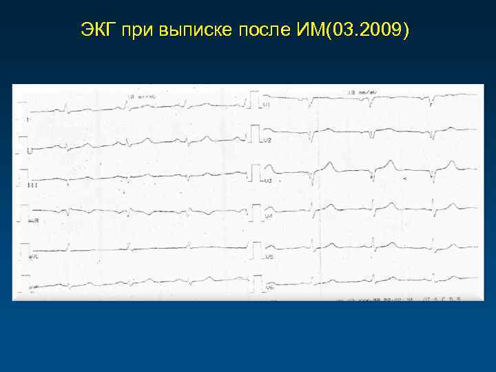 ЭКГ при выписке после ИМ(03. 2009) 