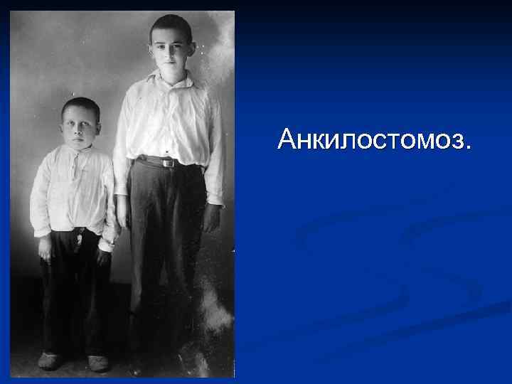 Анкилостомоз. 