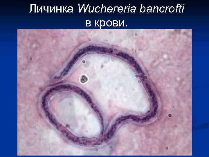 Личинка Wuchereria bancrofti в крови. 