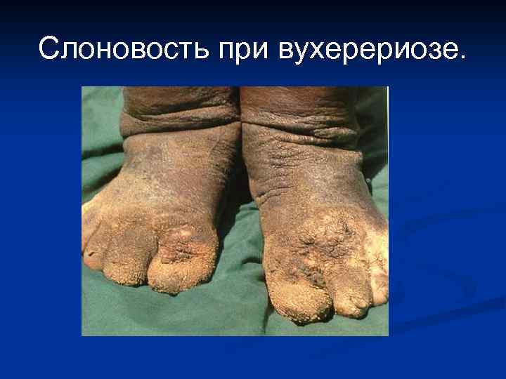 Слоновость при вухерериозе. 