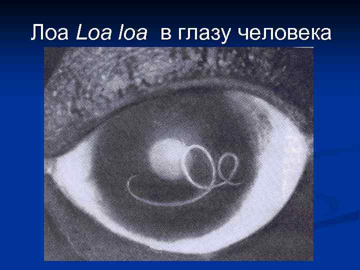 Лоа Loa loa в глазу человека 