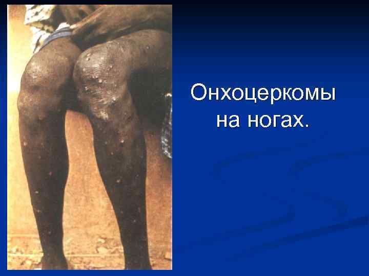 Онхоцеркомы на ногах. 
