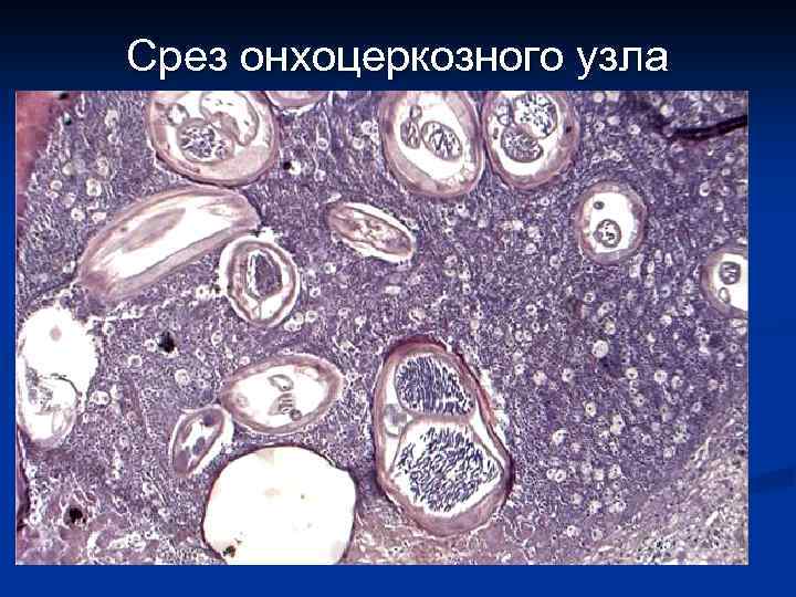 Срез онхоцеркозного узла 