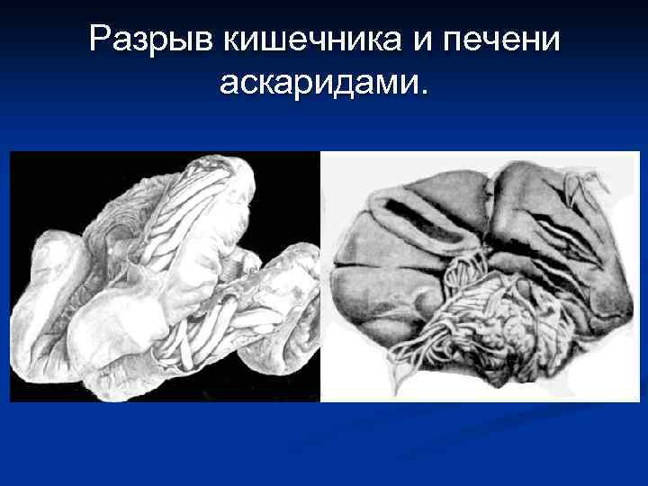 Разрыв кишечника и печени аскаридами. 