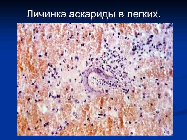 Личинка аскариды в легких. 